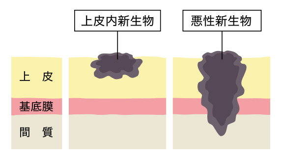 上皮内新生物 悪性新生物